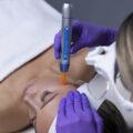 bt-titan®-MN-dermapen-za-mikro-piling-mikro-hr-shop-za-kozmeticke-salone-profesionalnu-opremu-zagreb-7