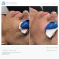 Bio-Brasion GEN4 mokro suha dijamantna mikrodermoabrazija mikro hr 06