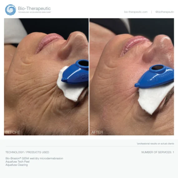 Bio-Brasion GEN4 mokro suha dijamantna mikrodermoabrazija mikro hr 06