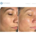 Bio-Brasion GEN4 mokro suha dijamantna mikrodermoabrazija mikro hr 07