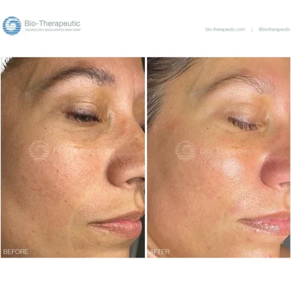Bio-Brasion GEN4 mokro suha dijamantna mikrodermoabrazija mikro hr 07