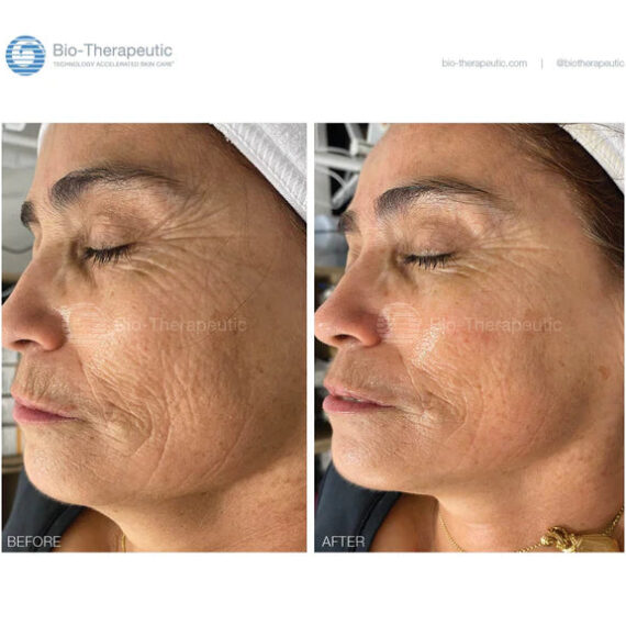 Bio-Brasion GEN4 mokro suha dijamantna mikrodermoabrazija mikro hr 08