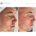 Bio-Brasion GEN4 mokro suha dijamantna mikrodermoabrazija mikro hr 09