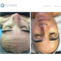 Bio-Brasion GEN4 mokro suha dijamantna mikrodermoabrazija mikro hr 10