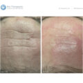 Bio-Brasion GEN4 mokro suha dijamantna mikrodermoabrazija mikro hr 11