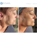 Bio-Brasion GEN4 mokro suha dijamantna mikrodermoabrazija mikro hr 12